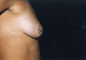 Breast Reconstruction 3c